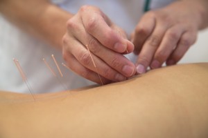 Treatment by acupuncture